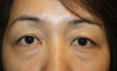 Blepharoplasty Before & After Patient #20163