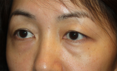 Blepharoplasty Before & After Patient #20163