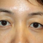 Blepharoplasty Before & After Patient #20163