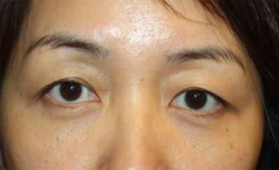 Blepharoplasty Before & After Patient #20163