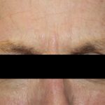 Botox and Dysport Before & After Patient #24780