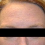 Botox and Dysport Before & After Patient #24780