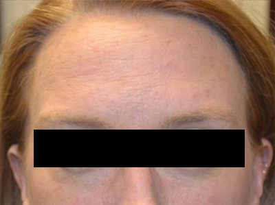 Botox and Dysport Before & After Patient #24780