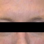 Botox and Dysport Before & After Patient #24780