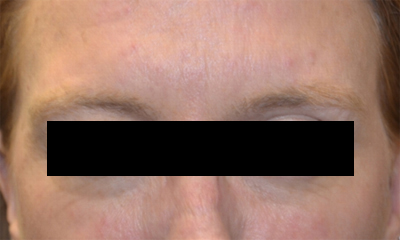 Botox and Dysport Before & After Patient #24780