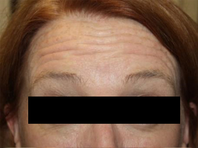 Botox and Dysport Before & After Patient #24780