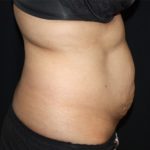 Tummy Tuck Before & After Patient #22504