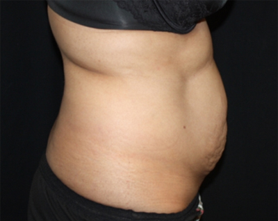 Tummy Tuck Before & After Patient #22504