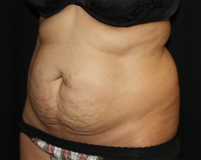 Tummy Tuck Before & After Patient #22504