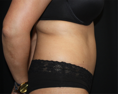 Tummy Tuck Before & After Patient #22504