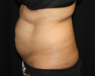Tummy Tuck Before & After Patient #22504