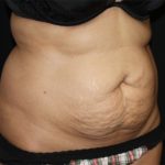 Tummy Tuck Before & After Patient #22504