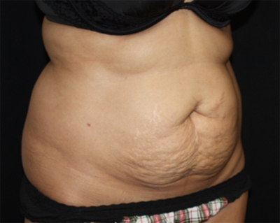 Tummy Tuck Before & After Patient #22504