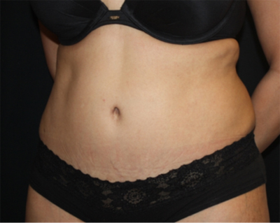 Tummy Tuck Before & After Patient #22504