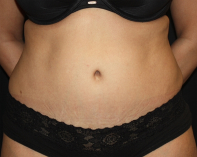 Tummy Tuck Before & After Patient #22504