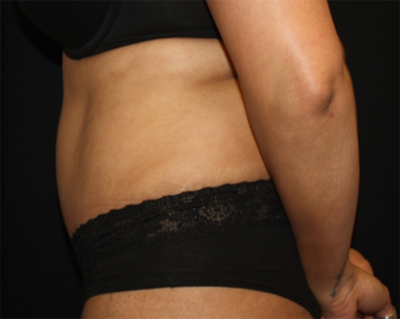 Tummy Tuck Before & After Patient #22504