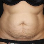 Tummy Tuck Before & After Patient #22504