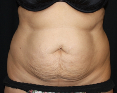 Tummy Tuck Before & After Patient #22504