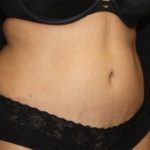 Tummy Tuck Before & After Patient #22504