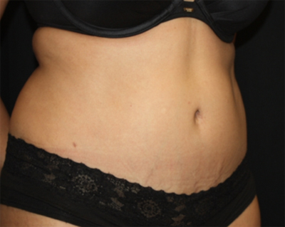 Tummy Tuck Before & After Patient #22504