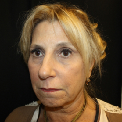 Facelift Before & After Patient #21180