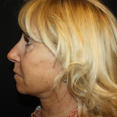 Facelift Before & After Patient #21180
