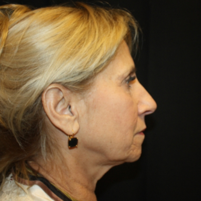 Facelift Before & After Patient #21180