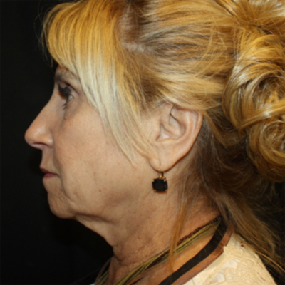 Facelift Before & After Patient #21180