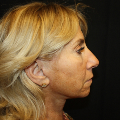 Facelift Before & After Patient #21180