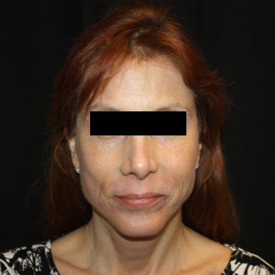 Facelift Before & After Patient #21158