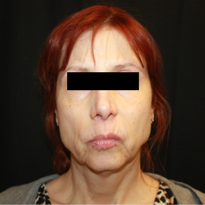 Facelift Before & After Patient #21158