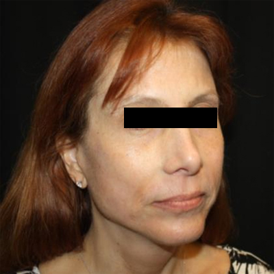 Facelift Before & After Patient #21158