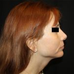 Facelift Before & After Patient #21158