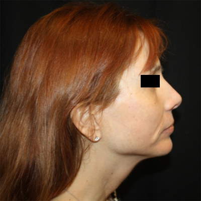 Facelift Before & After Patient #21158