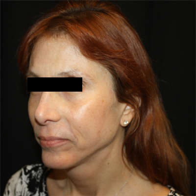 Facelift Before & After Patient #21158