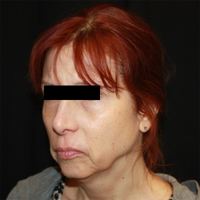 Facelift Before & After Patient #21158