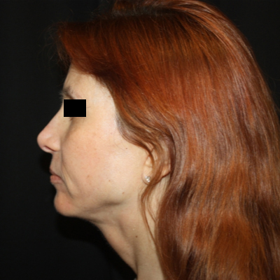 Facelift Before & After Patient #21158