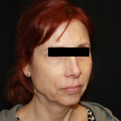 Facelift Before & After Patient #21158