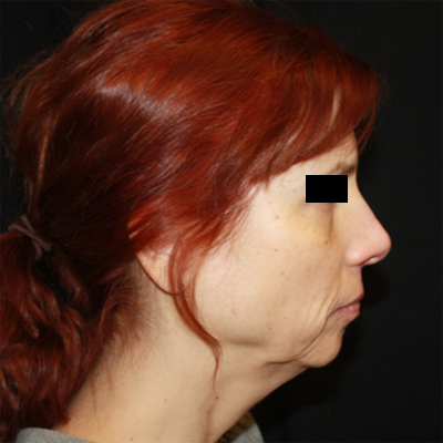 Facelift Before & After Patient #21158