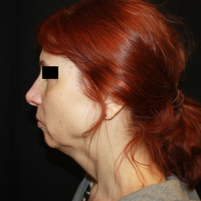 Facelift Before & After Patient #21158