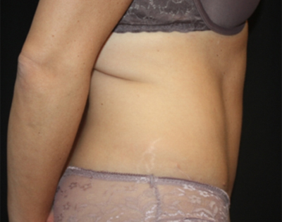 Tummy Tuck Before & After Patient #22489