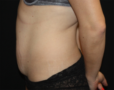 Tummy Tuck Before & After Patient #22489