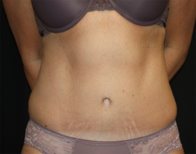 Tummy Tuck Before & After Patient #22489