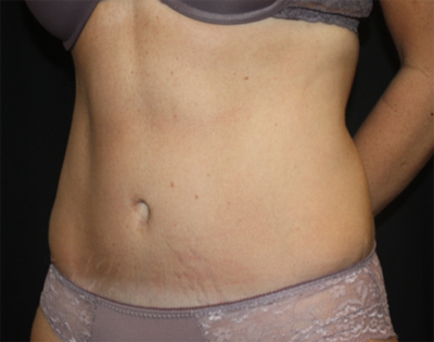 Tummy Tuck Before & After Patient #22489