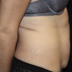 Tummy Tuck Before & After Patient #22489