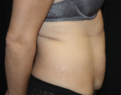 Tummy Tuck Before & After Patient #22489