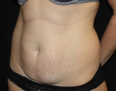 Tummy Tuck Before & After Patient #22489