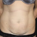 Tummy Tuck Before & After Patient #22489