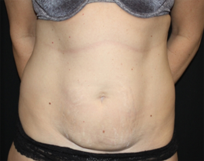 Tummy Tuck Before & After Patient #22489