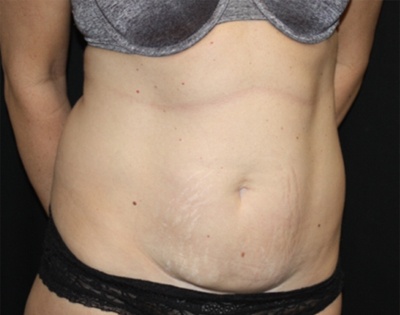 Tummy Tuck Before & After Patient #22489